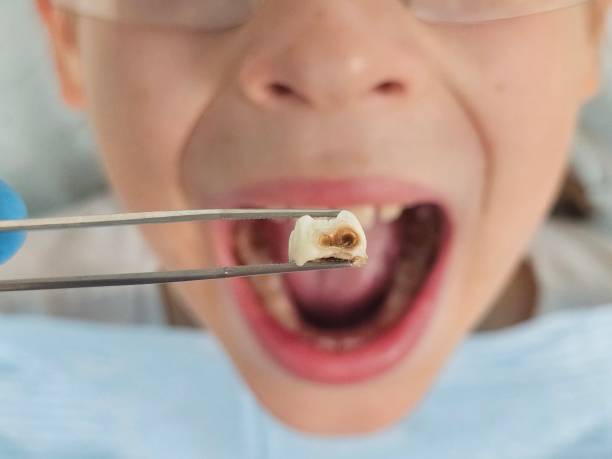 Best Emergency Tooth Extraction in Brentwood, TN